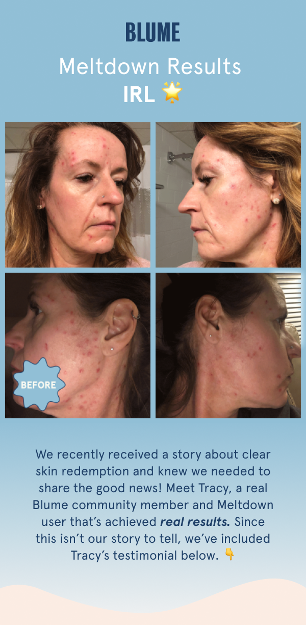 Meet Tracy! Real Blume community member with real meltdown results. 
